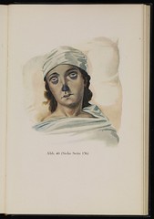 165x. HLJ2 Young_girl_suffering_from_cholera._Baumgartner,_1929_Wellcome_L0074303