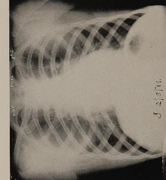 This image is taken from The correlation of x-ray findings and physical signs in the chest in uncomplicated epidemic influenza