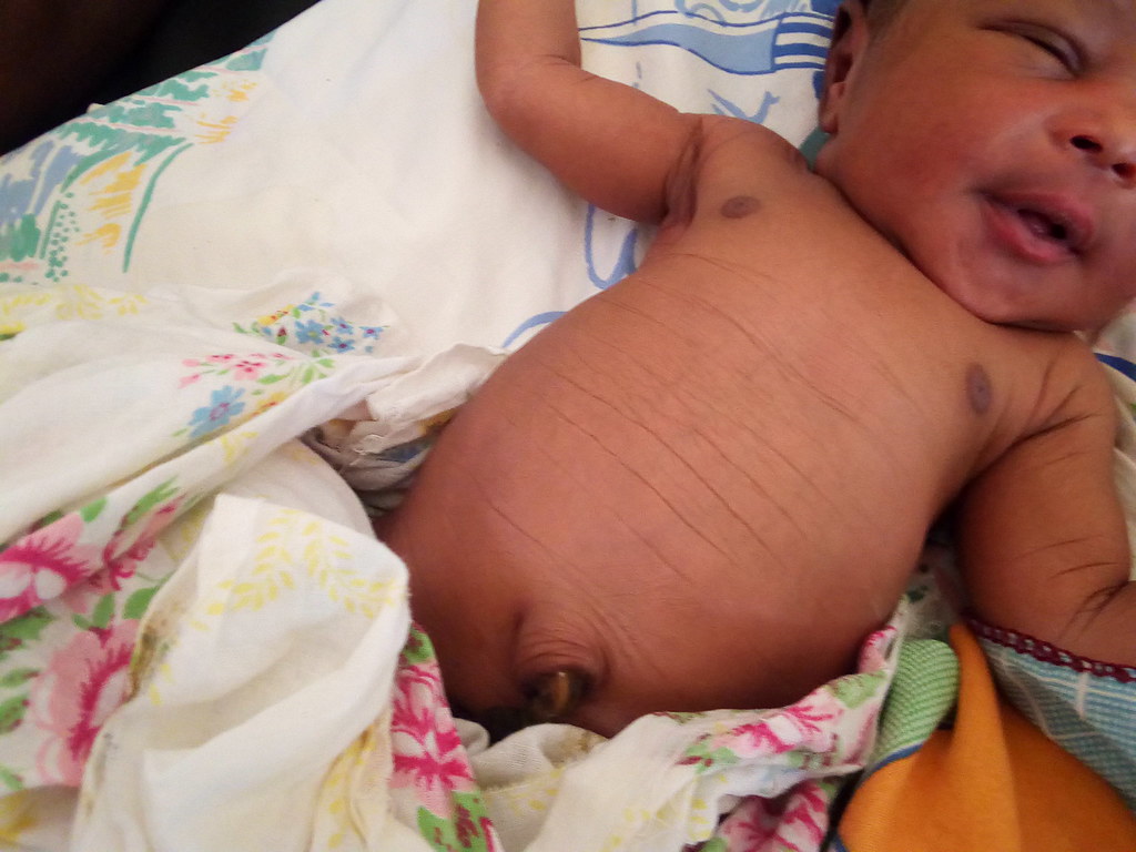 Health newborn as result of CHX application
