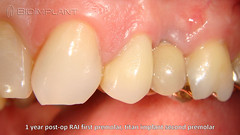 5 one year post-op RAI first premolar, titan implant second premolar