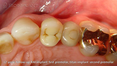 9 twelf years follow-up RAI Implant treatment first premolar, titan implant second premolar Bioimplant