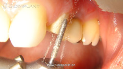 3 crown preperation custom implant