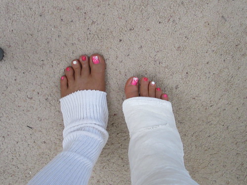 Leg in a Cast Toes Out