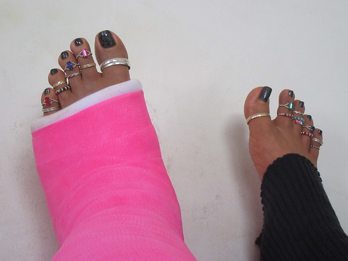 My Cast, Crutches and Toes
