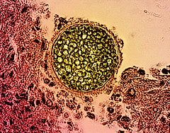 Valley Fever/Coccidioides Fungal Spherule