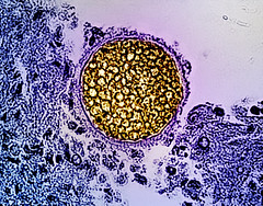 Valley Fever/Coccidioides Fungal Spherule